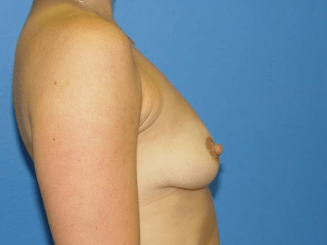 Mommy Makeover Patient 03 (Breast Augmentation and Tummy Tuck) View 5 - Before Thumbnail