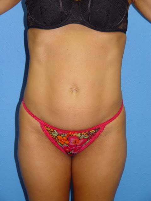 Mommy Makeover Patient 03 (Breast Augmentation and Tummy Tuck) View 1 - Before Thumbnail
