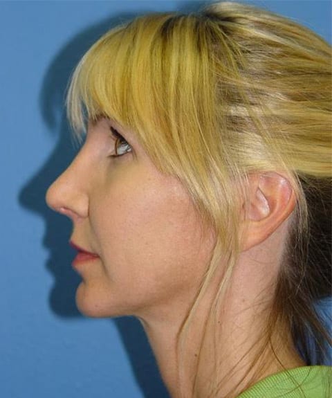 Rhinoplasty Patient 04 View 2 - After Thumbnail