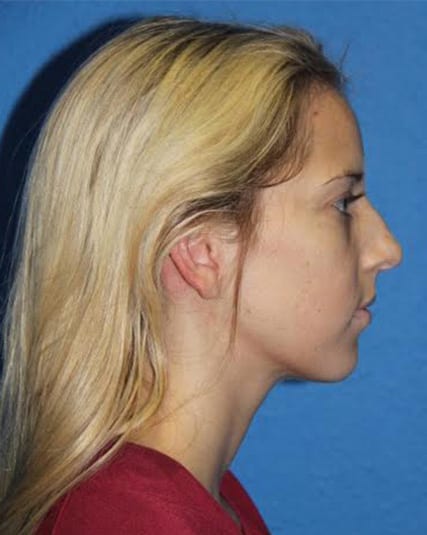 Rhinoplasty Patient 01 View 4 - Before Thumbnail