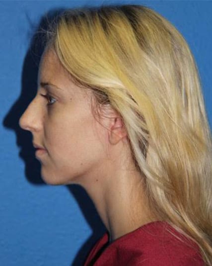 Rhinoplasty Patient 01 View 3 - Before Thumbnail
