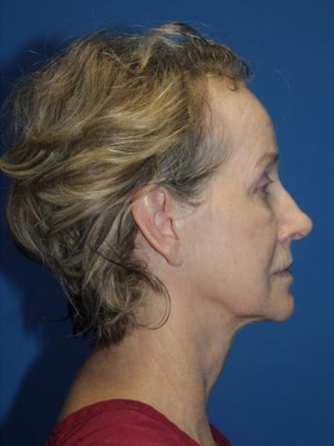 Facelift Patient 08 View 2 - Before Thumbnail