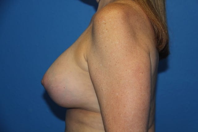 Breast Lift with  Augmentation 04 View 2 - After Thumbnail