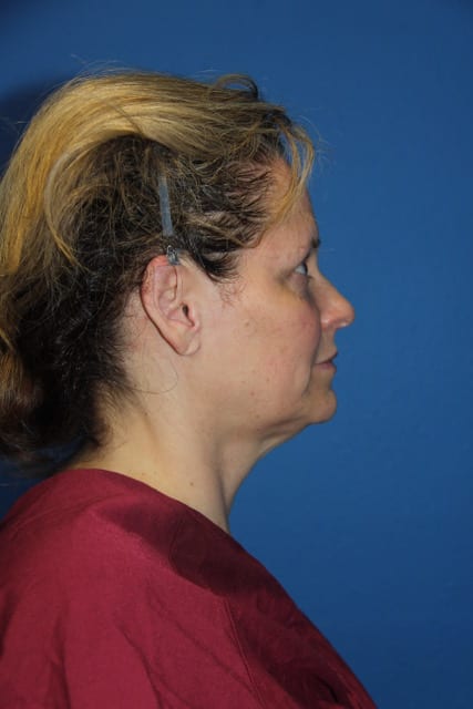 Facelift Patient 10 View 1 - Before Thumbnail