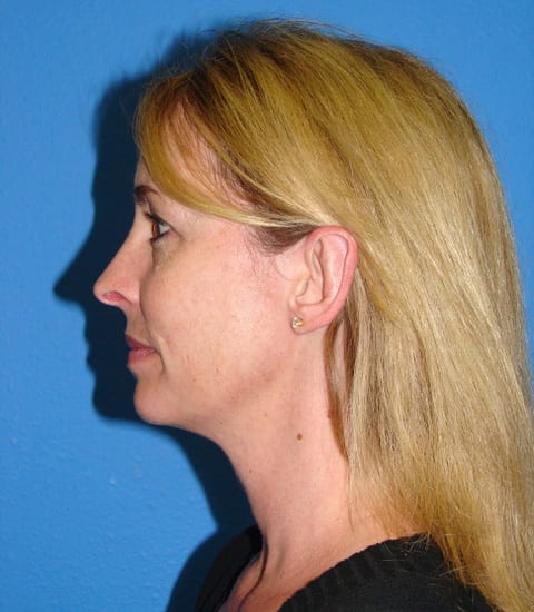 Otoplasty Patient 03 View 3 - After Thumbnail
