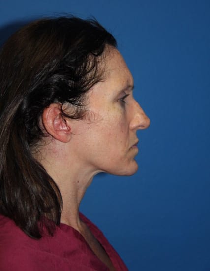 Rhinoplasty Patient 06 View 2 - Before Thumbnail