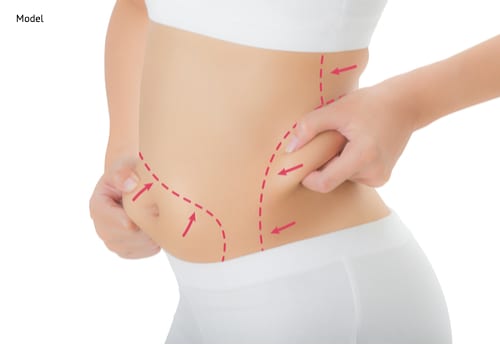 Liposuction vs. UltraShape®: Which Is Better?