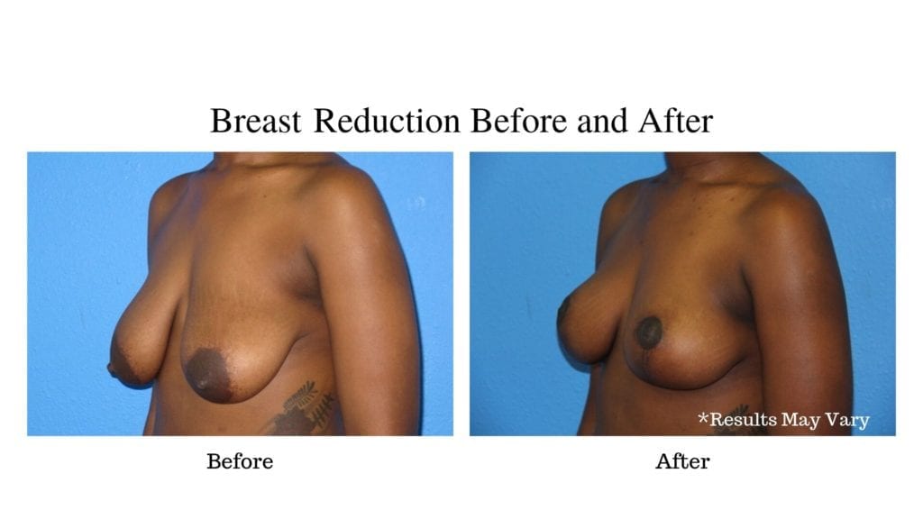 How Does Breast Reduction Differ Between Men and Women?