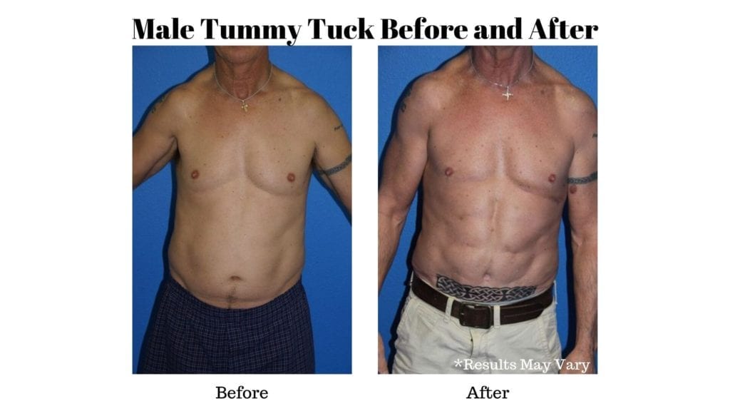 Male Tummy Tuck Patient