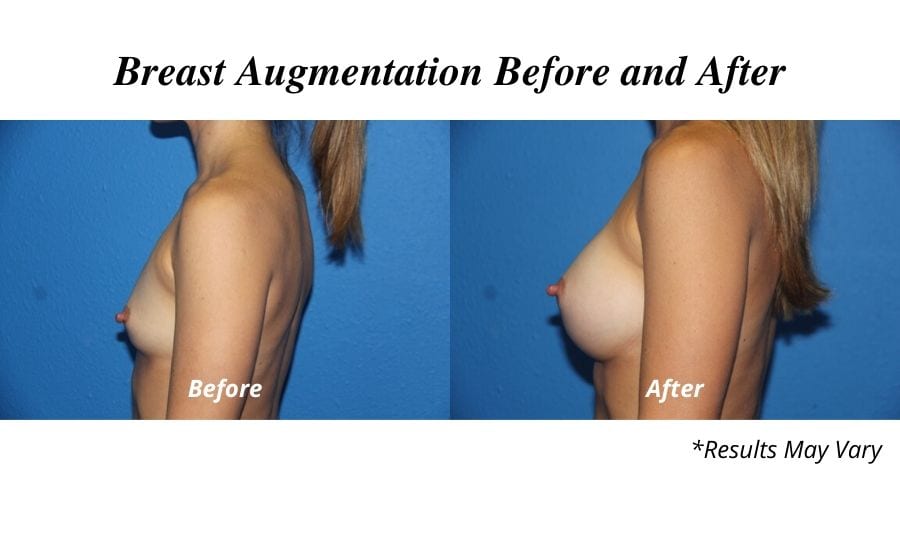 Before and after image showing the results of a breast augmentation performed in Tampa, FL.