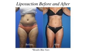 Before and after image showing the results of a liposuction procedure performed by Dr. Halpern in Tampa, Florida.