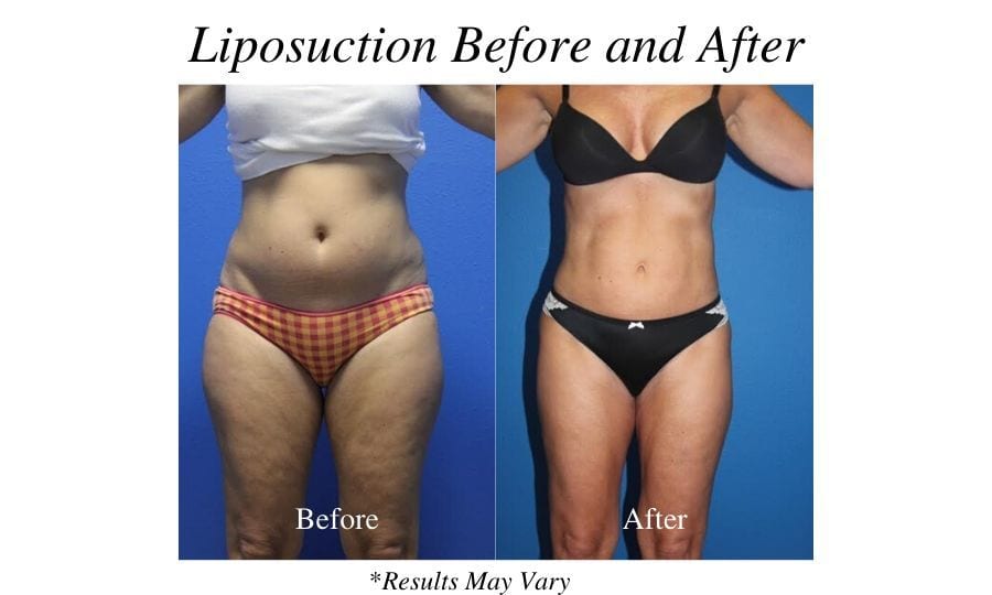 Can the UltraShape® Power Rival Liposuction?