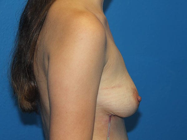 Breast Implant Removal Patient 01 View 2 - After Thumbnail