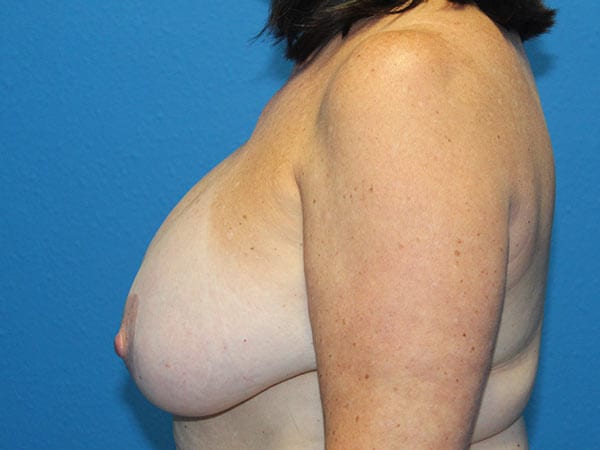 Breast Implant Removal and Breast Lift Patient 02 View 2 - Before Thumbnail