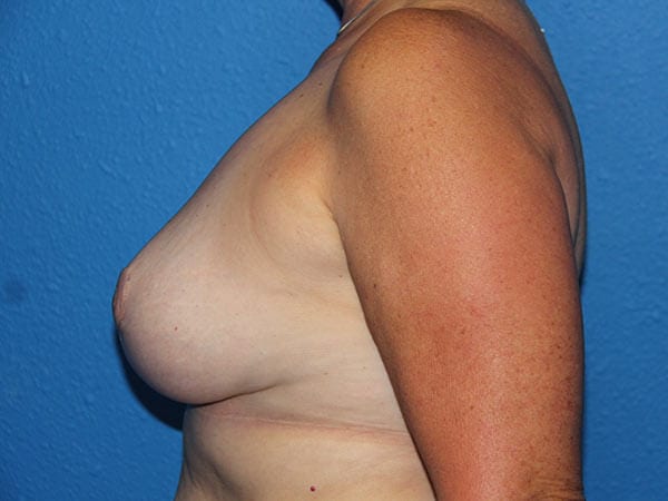 Breast Implant Removal and Breast Lift Patient 01 View 2 - After Thumbnail