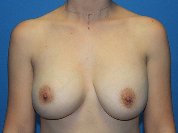 Breast Implant Removal Patient 01 View 1 - Before Thumbnail