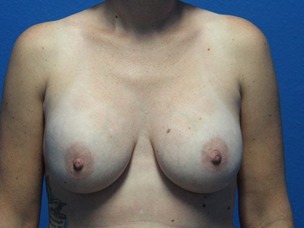 Breast Implant Removal Patient 03 View 1 - Before Thumbnail