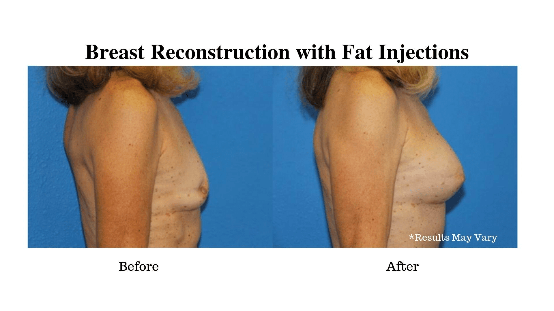 Dr. Halpern's breast reconstruction with fat injection patient before and after her surgery.