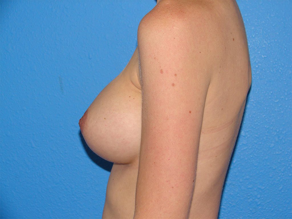 Breast Augmentation Patient 09 View 4 - After Thumbnail