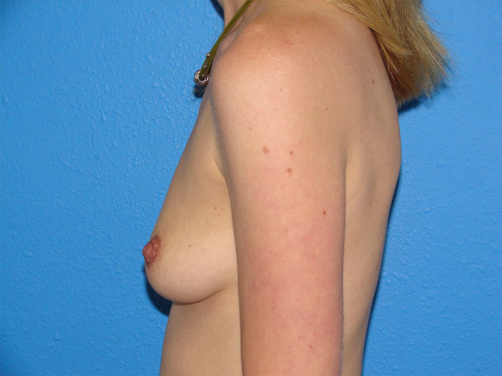 Breast Augmentation Patient 09 View 4 - Before Thumbnail