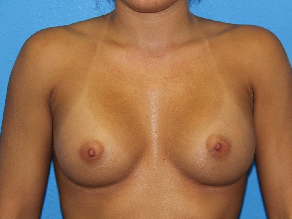 Breast Augmentation Patient 10 View 1 - After Thumbnail