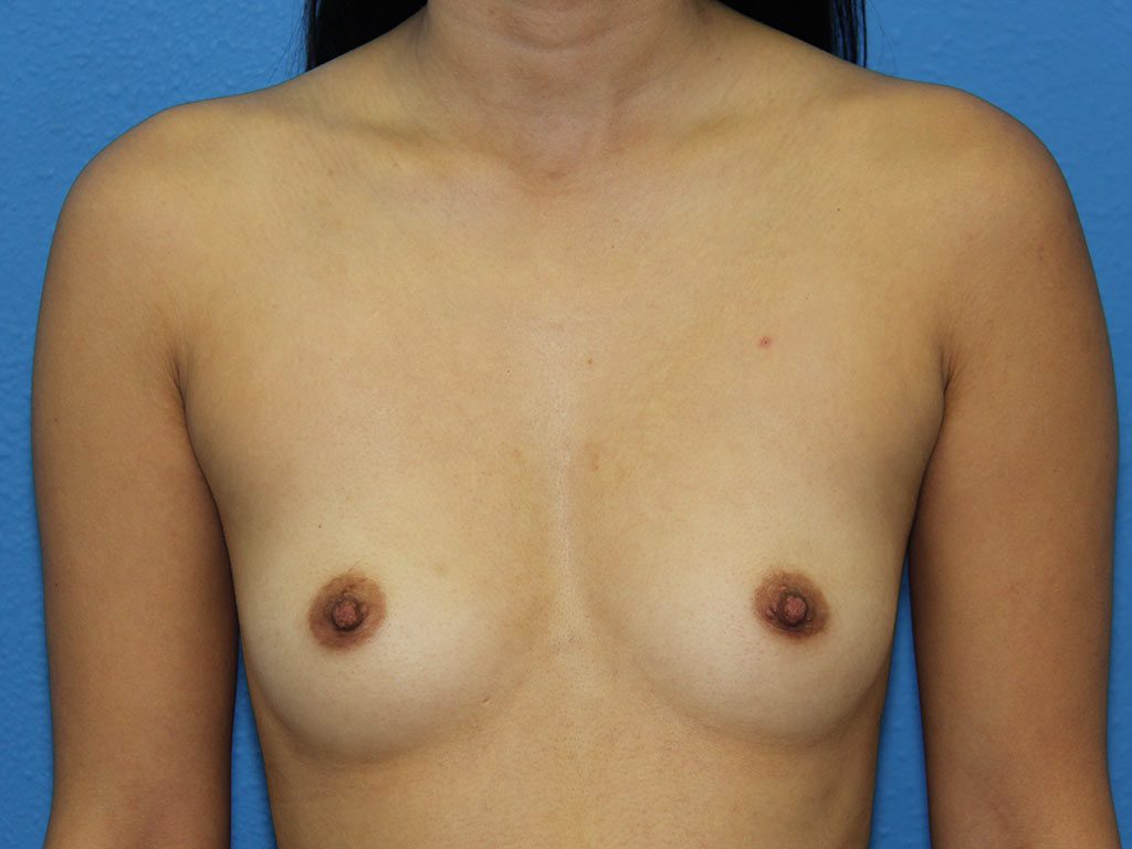 BREAST AUGMENTATION PATIENT 12 View 1 - Before Thumbnail