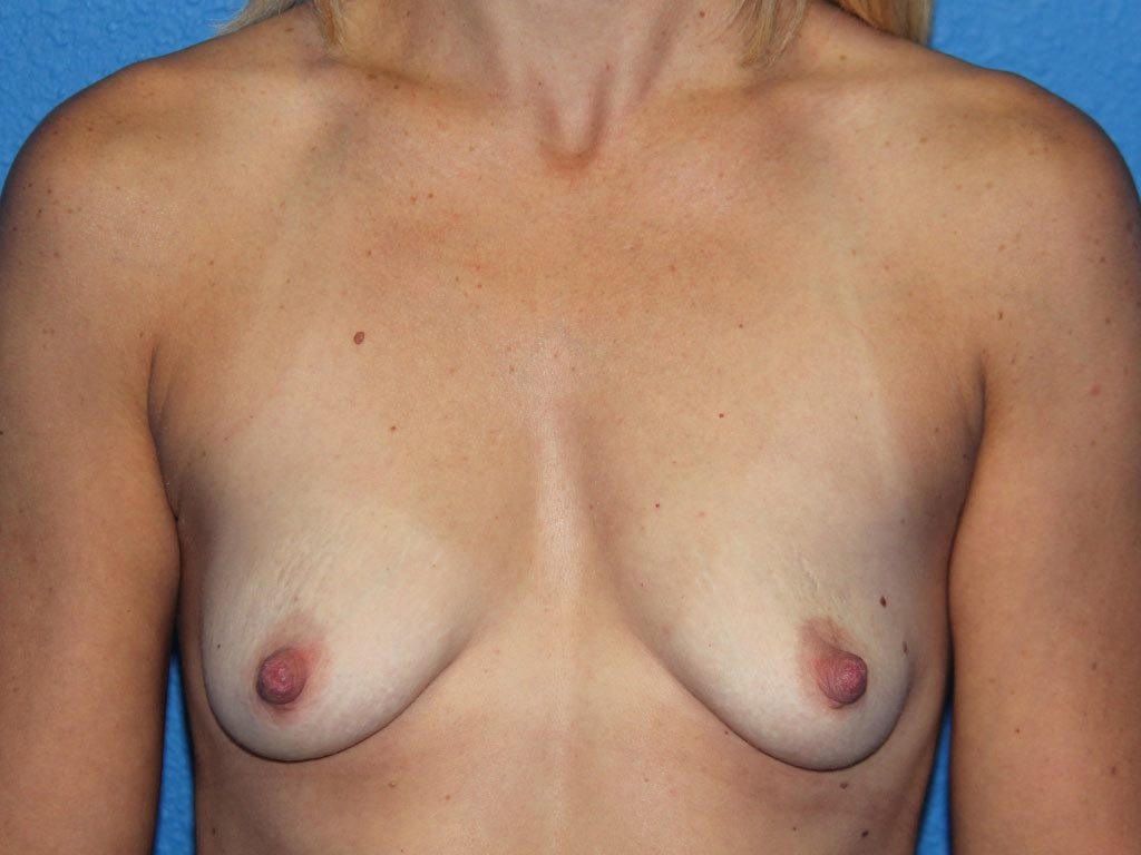 BREAST AUGMENTATION PATIENT 13 View 1 - Before Thumbnail