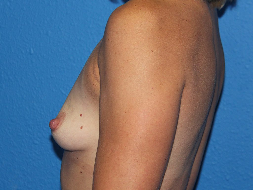 BREAST AUGMENTATION PATIENT 13 View 4 - Before Thumbnail