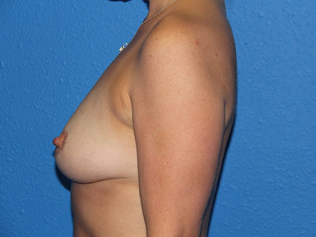 BREAST AUGMENTATION PATIENT 15 View 3 - Before Thumbnail