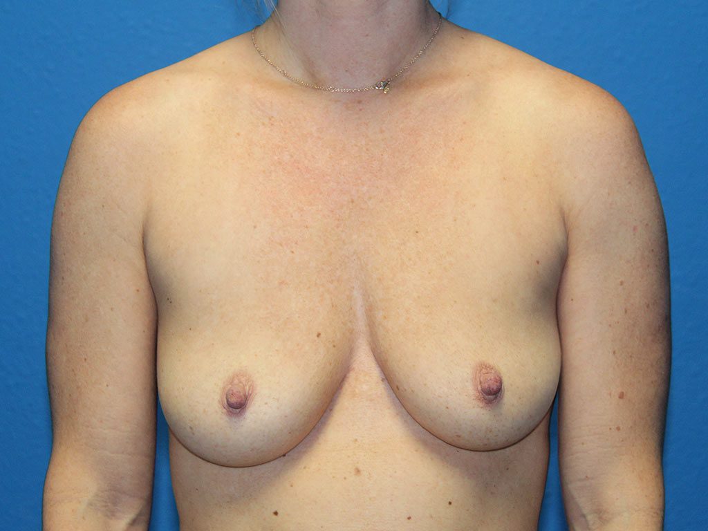 BREAST AUGMENTATION PATIENT 16 View 1 - Before Thumbnail