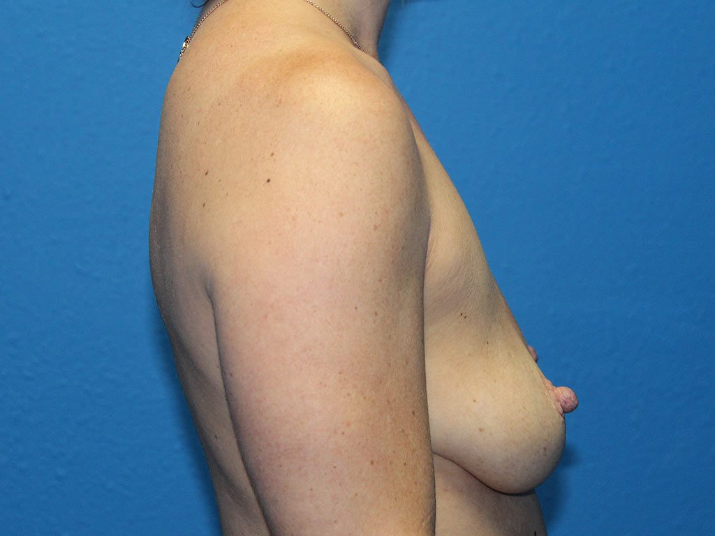 BREAST AUGMENTATION PATIENT 16 View 4 - Before Thumbnail