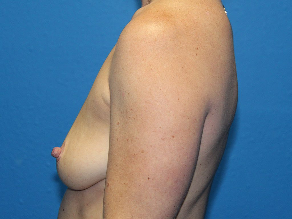 BREAST AUGMENTATION PATIENT 16 View 3 - Before Thumbnail
