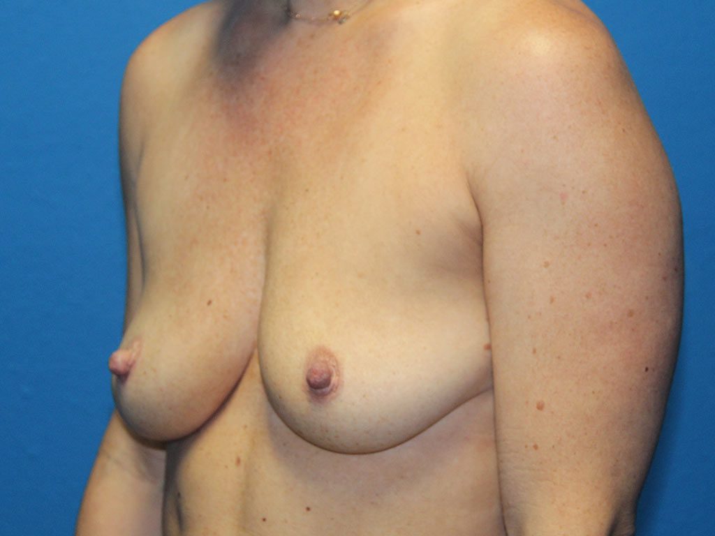 BREAST AUGMENTATION PATIENT 16 View 2 - Before Thumbnail