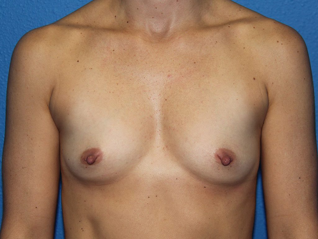 BREAST AUGMENTATION PATIENT 17 View 1 - Before Thumbnail