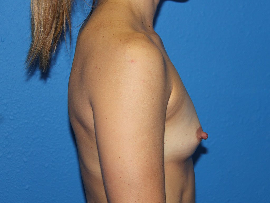 BREAST AUGMENTATION PATIENT 17 View 4 - Before Thumbnail