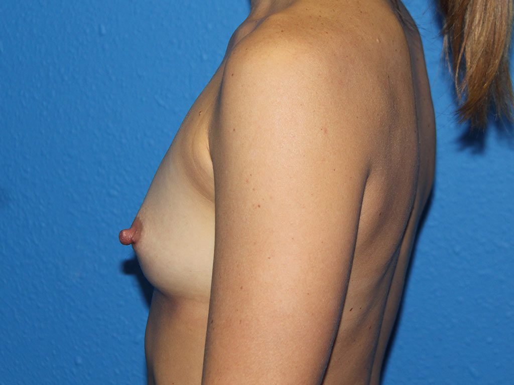 BREAST AUGMENTATION PATIENT 17 View 3 - Before Thumbnail