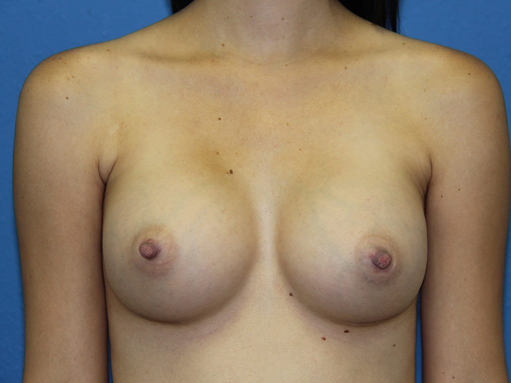 BREAST AUGMENTATION PATIENT 18 View 1 - After Thumbnail