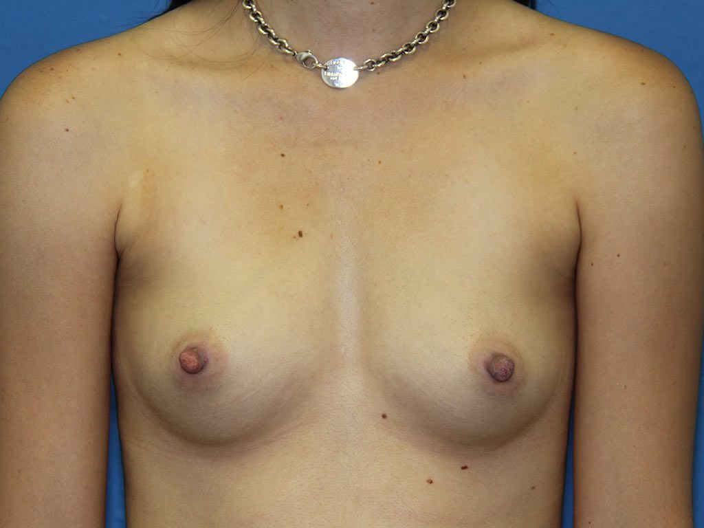 BREAST AUGMENTATION PATIENT 18 View 1 - Before Thumbnail