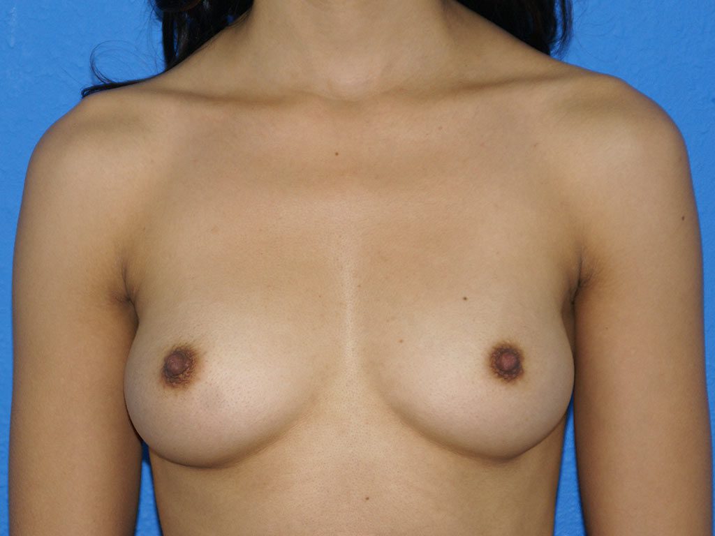 Breast Augmentation Patient 20 View 1 - Before Thumbnail