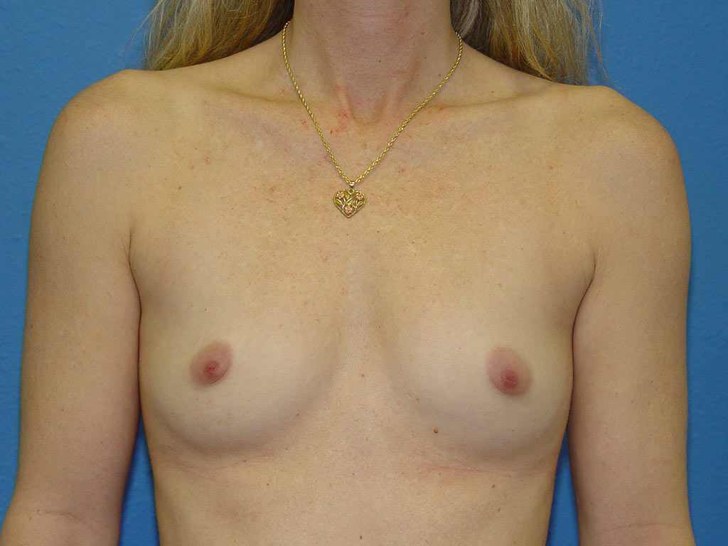 Breast Augmentation Patient 08 View 1 - Before Thumbnail