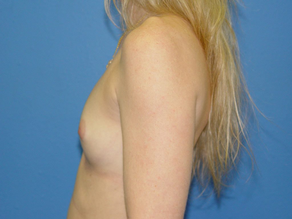 Breast Augmentation Patient 08 View 3 - Before Thumbnail