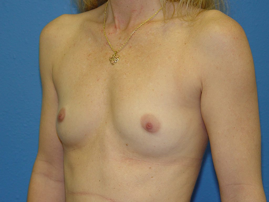 Breast Augmentation Patient 08 View 2 - Before Thumbnail