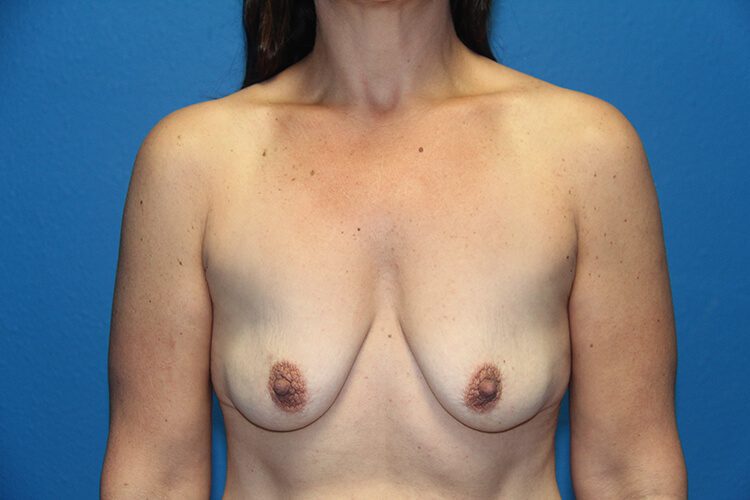 Breast Augmentation Patient 22 View 1 - Before Thumbnail