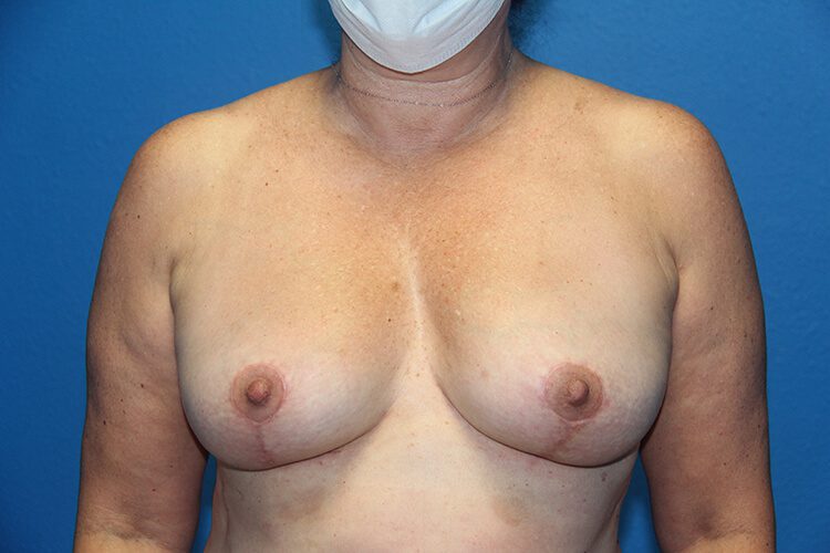 Breast Implant Removal and Breast Lift Patient 03 View 1 - After Thumbnail