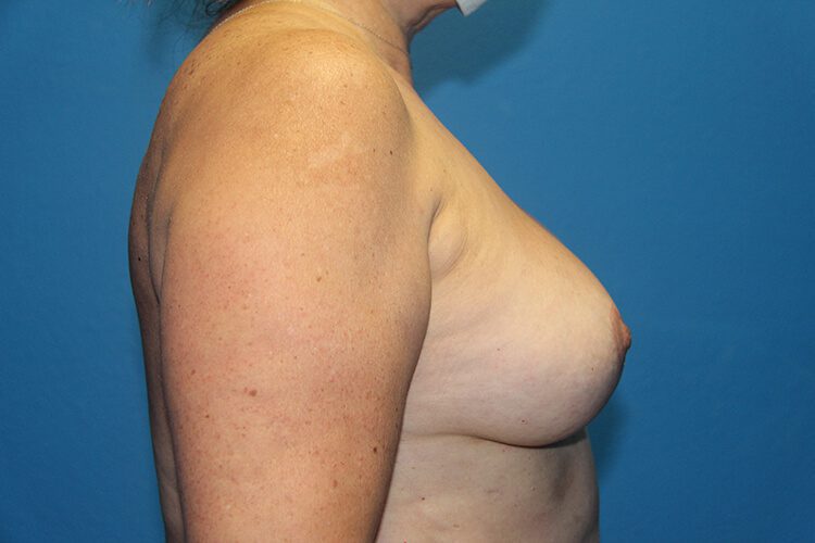 Breast Implant Removal and Breast Lift Patient 03 View 2 - After Thumbnail