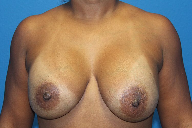 Breast Implant Removal and Breast Lift Patient 05 View 1 - Before Thumbnail