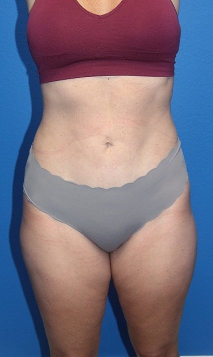 LIPOSUCTION W RENUVION PATIENT View 1 - After Thumbnail