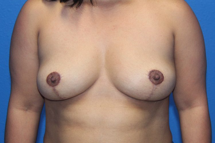 Breast Implant Removal and Breast Lift Patient 06 View 1 - After Thumbnail