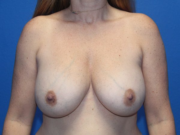 Breast Implant Removal and Breast Lift Patient 07 View 1 - Before Thumbnail