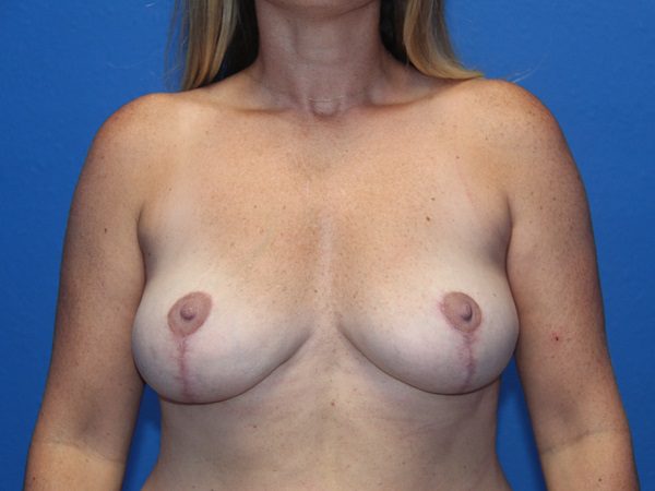 Breast Implant Removal and Breast Lift Patient 07 View 1 - After Thumbnail